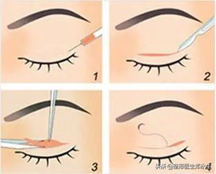 眶周治疗,眶周水肿的处理