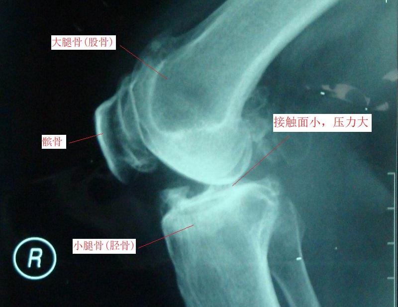 上下楼梯时膝关节痛的原因及康复方法