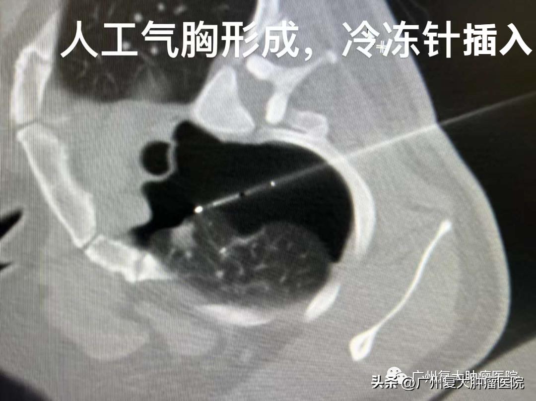 肺结节在内部如何切除,肺气管结节怎么治疗效果最好