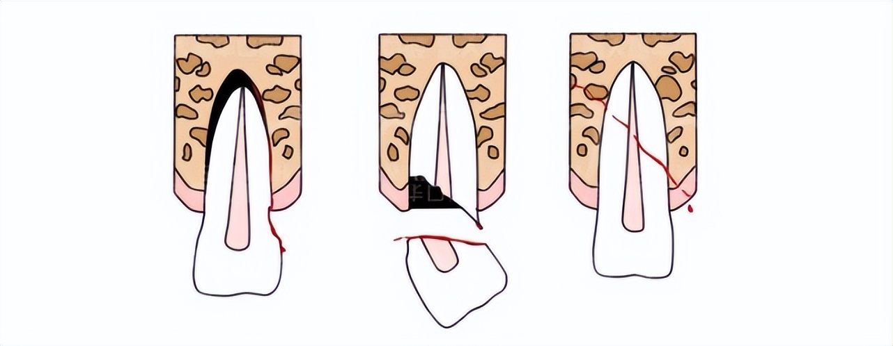 没蛀牙但是牙一阵一阵疼,没蛀牙却牙疼