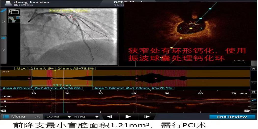 天津oct冠脉介入治疗,oct检查为冠心病诊治带来的启示