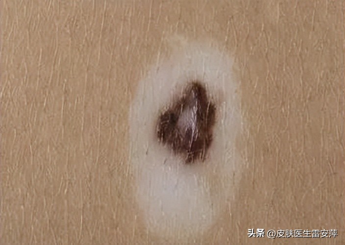 晕痣型白癜风怎么治疗,晕痣型白癜风治疗方法