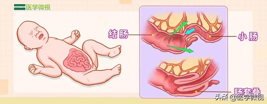 脾胃消化不好腹痛腹胀积食便秘,长期腹痛腹胀腹泻便秘怎么回事