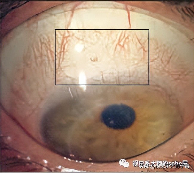 巩膜镜的验配技巧及案例分享,试戴巩膜镜成功率高不高