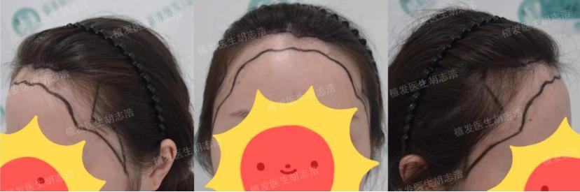 植发后后枕部的头发多久能恢复,植发手术后3个月恢复过程