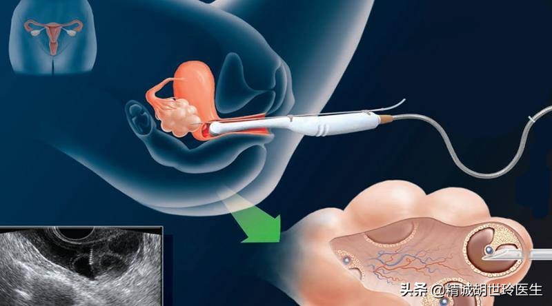取完卵后稍微站着右侧就会痛,取完卵后右边卵巢针扎样痛