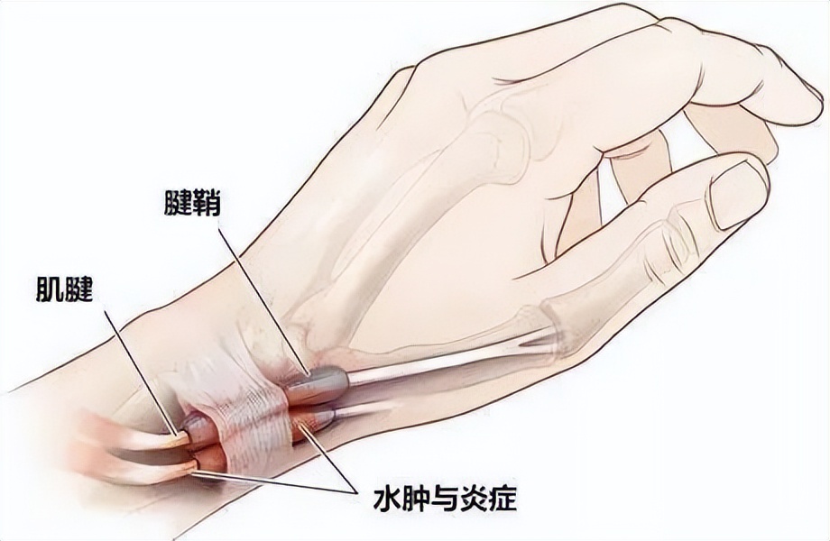 一招治腱鞘炎,脚部腱鞘炎三个动作自愈方法