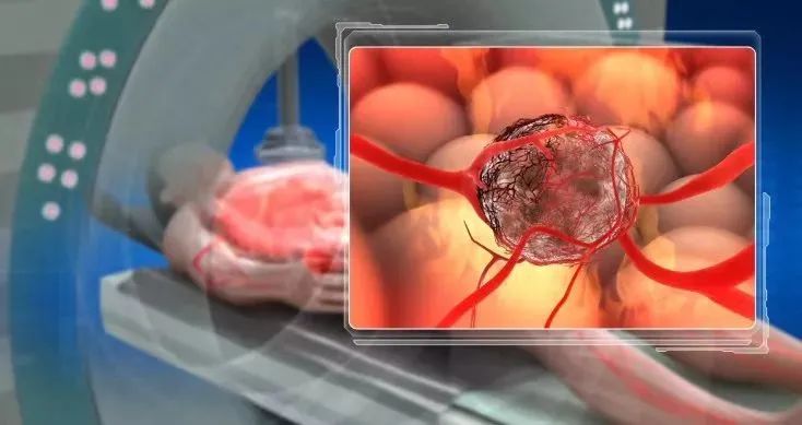 肝癌复发怎么治疗最有效,肝癌反复复发能消融治疗吗