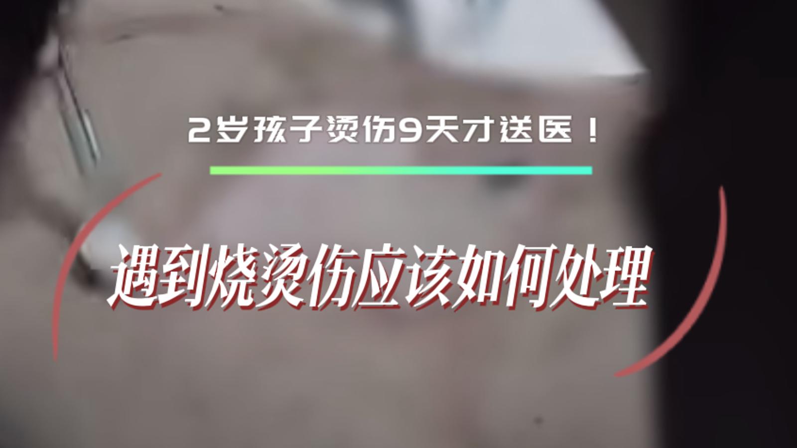 2岁孩子烫伤9天才送医！遇到烧烫伤我们应该如何处理
