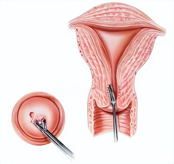 宫颈活检一般要夹几块肉出来,妇科活检需要打麻药吗