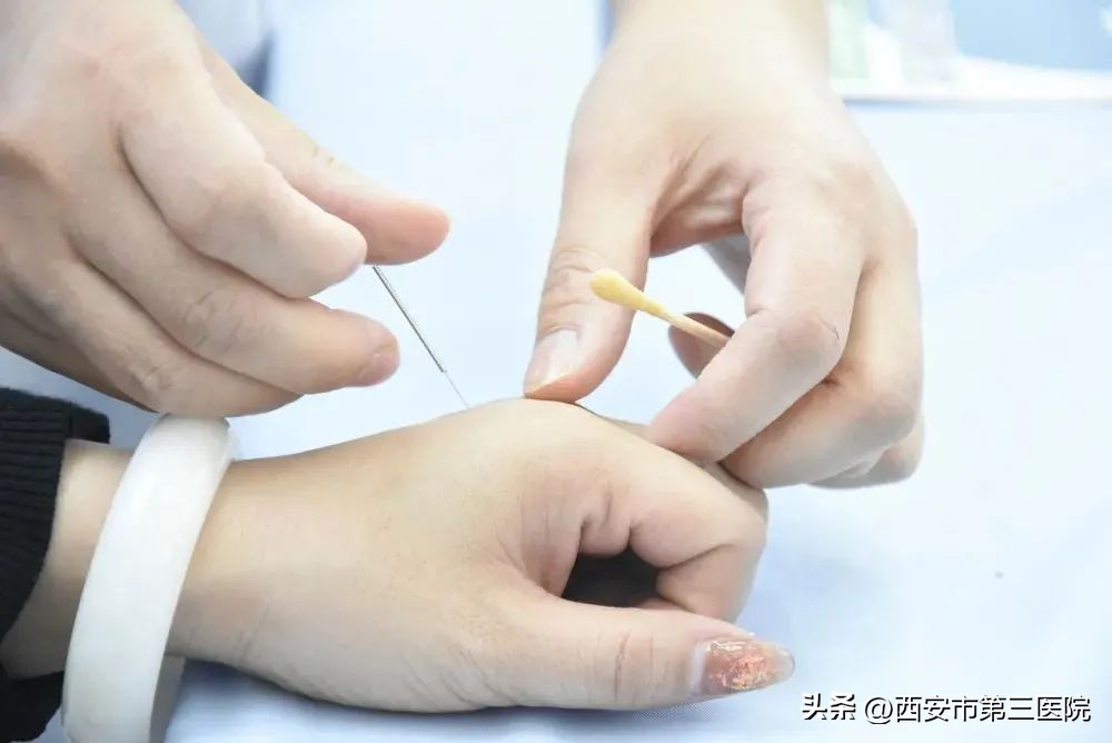 针灸推拿治疗落枕的方法,针灸治疗颈椎落枕