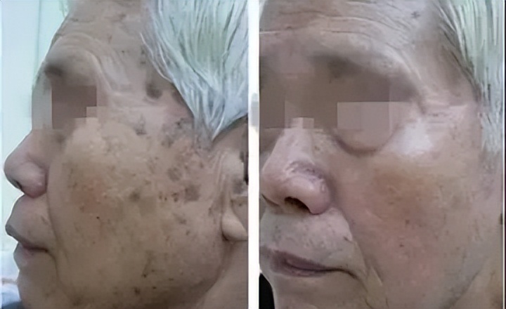 老年色素沉着斑怎么消除,色素沉着老年斑能去除吗