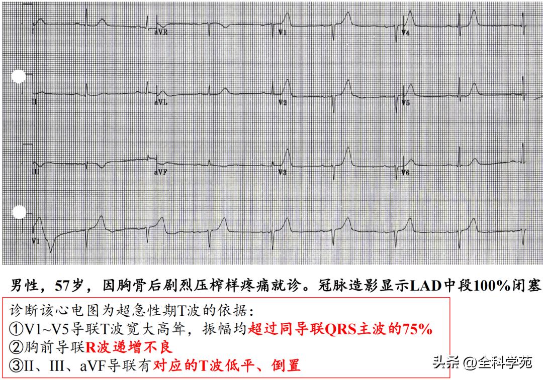 t波高尖心电图判断标准,t波高尖判断标准
