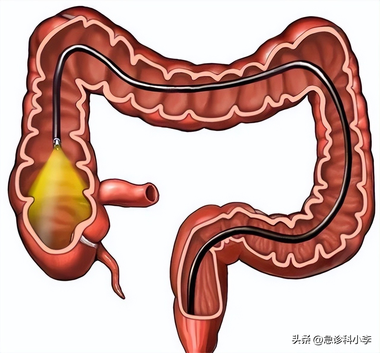 肠道为什么反复长息肉如何预防,如果肠道长息肉身体会有哪些反应