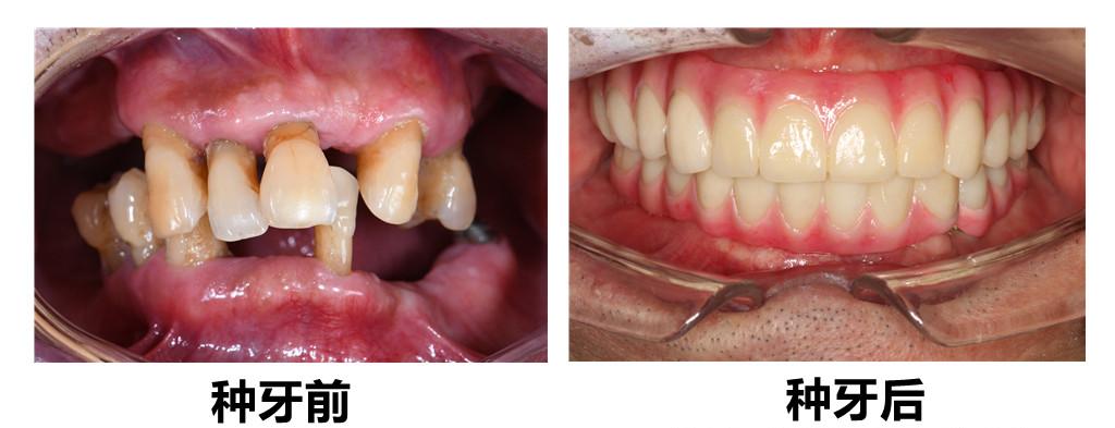 老人什么假牙又便宜又耐用,烤瓷假牙哪个厂家的质量最好耐用