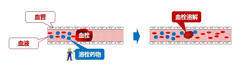 什么是溶栓/取栓时间窗？错过了还能恢复吗？