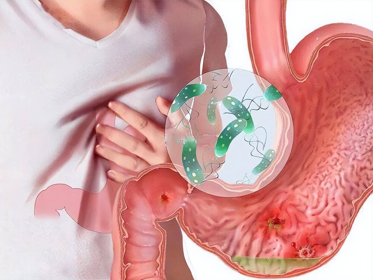 几块一瓶的甲硝唑能治4种病,一瓶甲硝唑