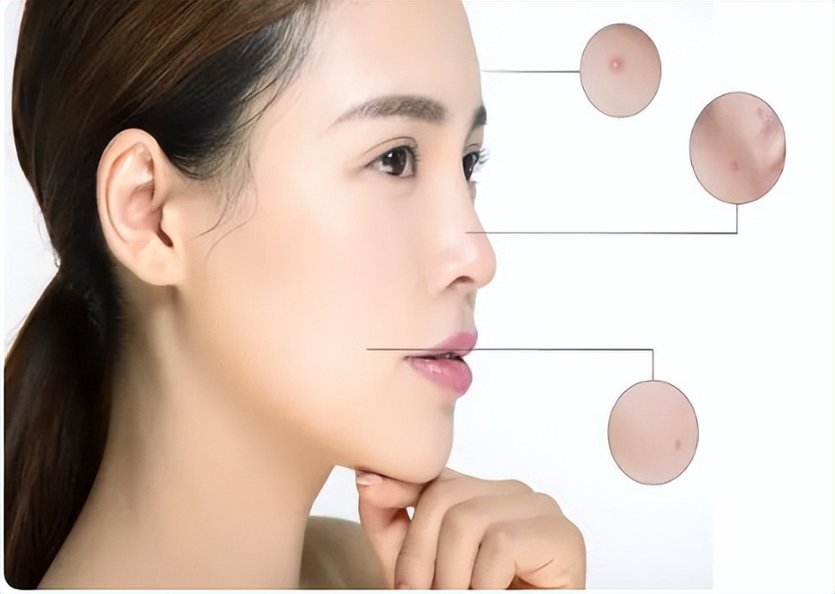 油脂粒粉刺怎么去除,萃雪肤祛痘产品副作用是啥