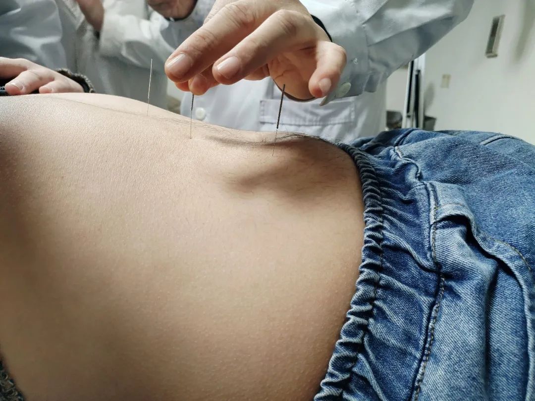 困扰患者十年的偏头痛一招解决,防治偏头痛从学会写头痛日记开始