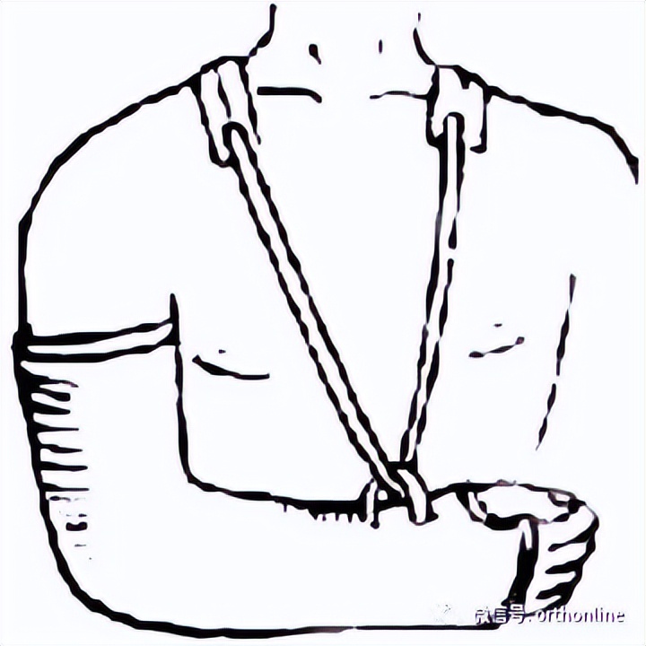 股骨干骨折保守治疗多久恢复,肱骨干骨折恢复过程中的四大禁忌