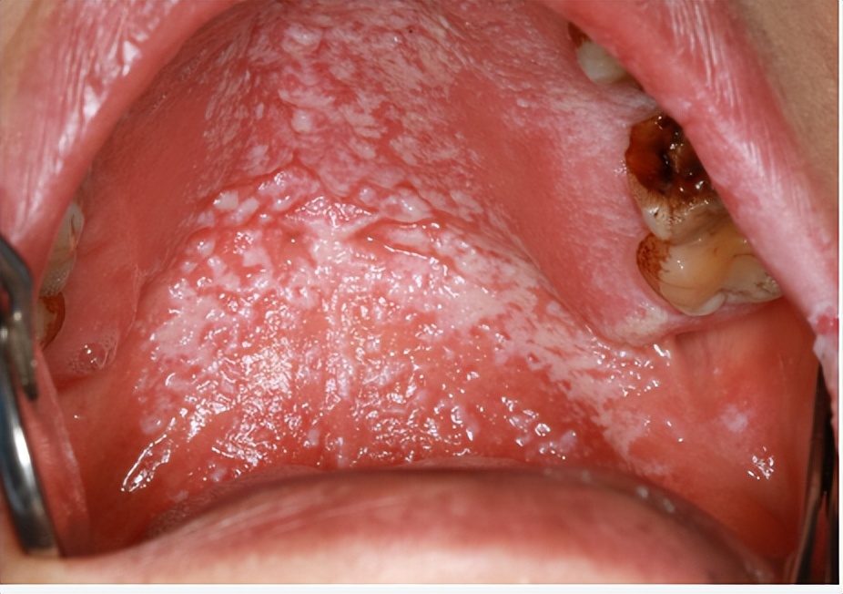 宝宝口腔有小白点是什么原因,五个月宝宝口腔上颚有白块图片