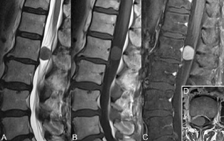 原发性肝癌的磁共振影像诊断,原发性腰椎肿瘤有哪些