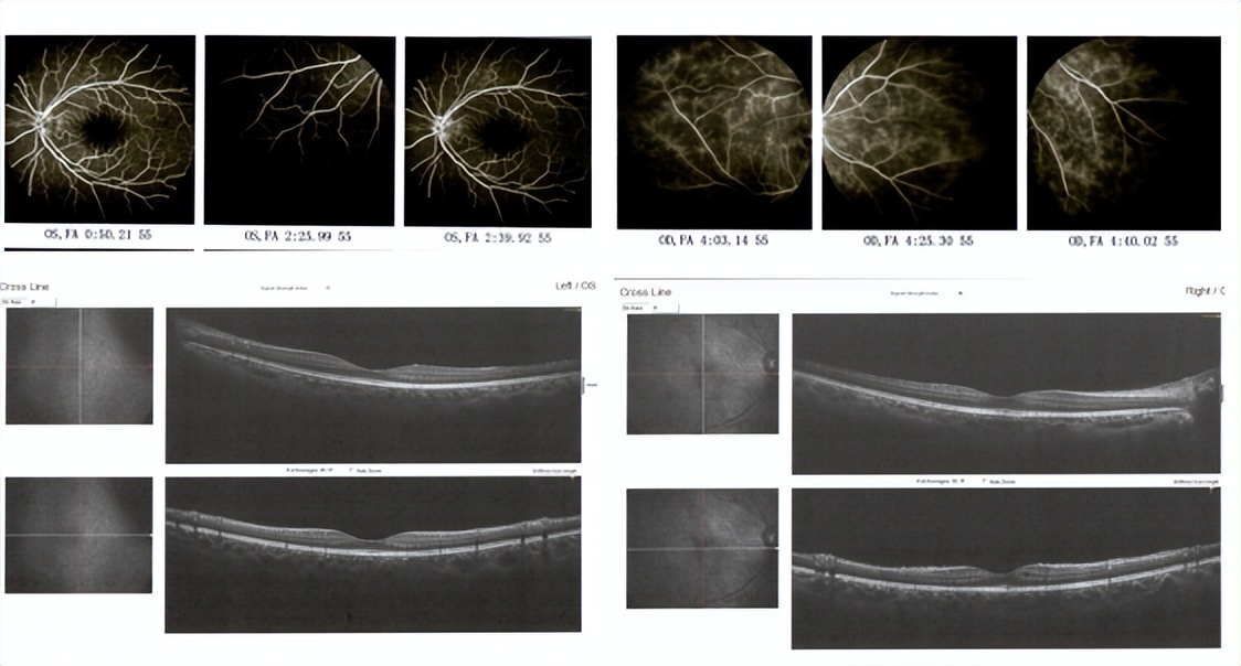阿达木单抗治疗皮肤病效果,阿达木单抗治疗葡萄膜炎