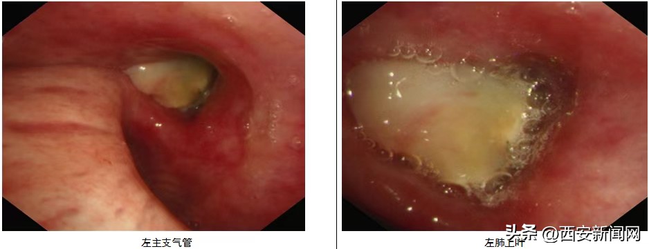 医院开展支气管镜下治疗,医院开展输尿管镜下钬激光碎石术