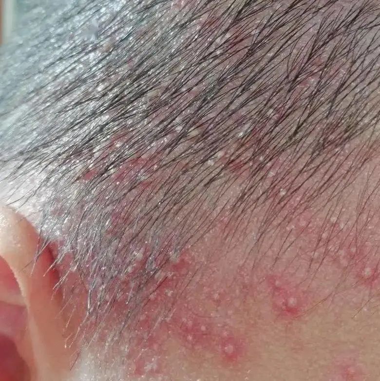 冬天也会有痱子,冬天也会长痱子