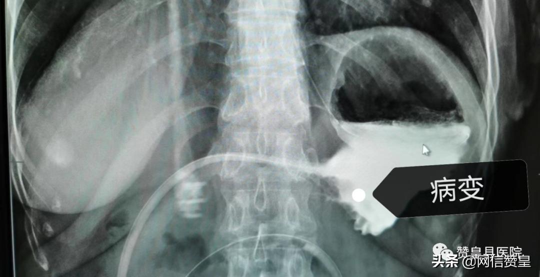 胃窦癌微创切除手术,胃窦癌介入栓塞