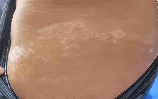 治疗白癜风近几年有何突破,白癜风11年