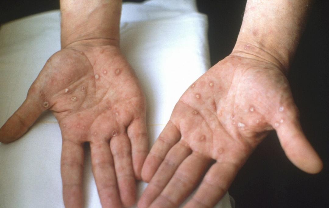 聊天记录曝光恶心一幕:老公说工作太累了长湿疹,其实是梅毒