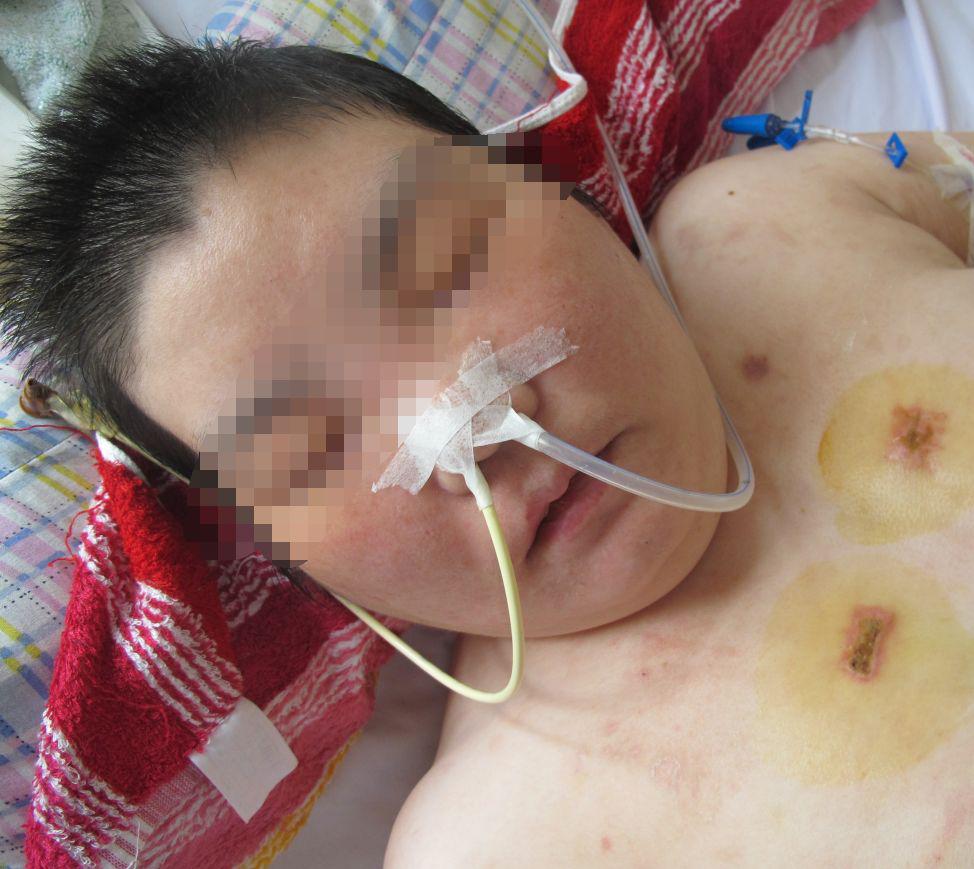 听神经瘤出现脑积水和出血,听神经瘤手术后颅压高症状