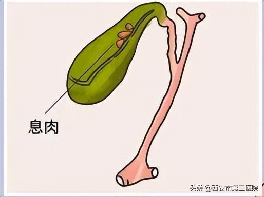 超声造影能鉴别胆囊息肉的性质吗,超声提示胆囊息肉样变什么意思