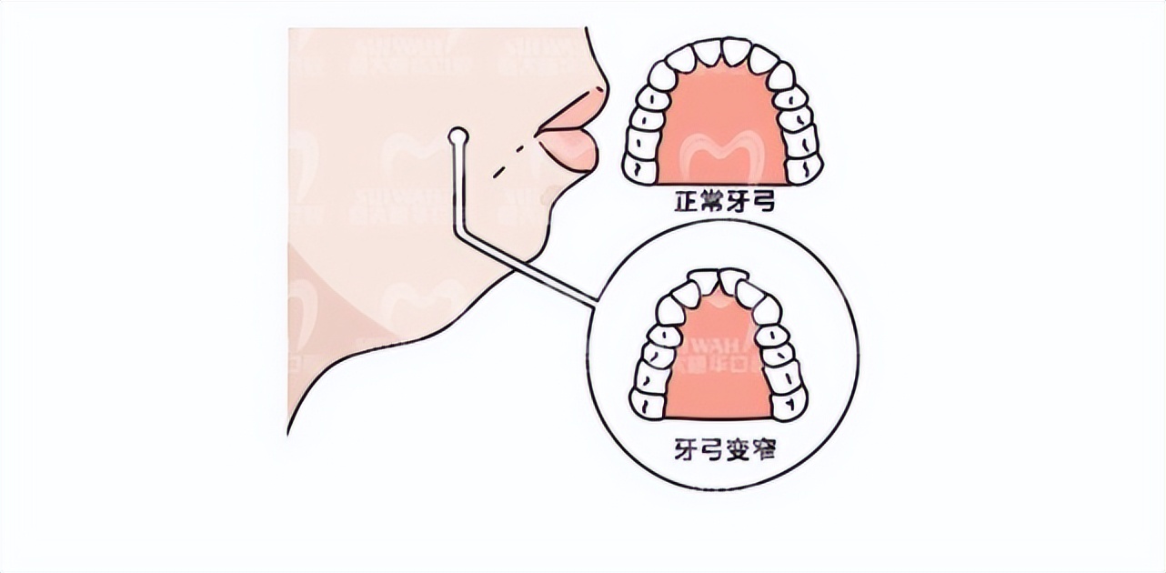 牙齿矫正一定要拔牙安全吗,牙齿矫正拔牙当天就可以矫正了吗