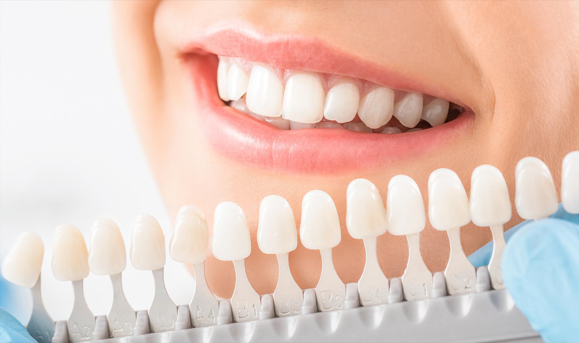 牙齿贴面什么材质经济又耐用,牙齿瓷贴面哪家做的好