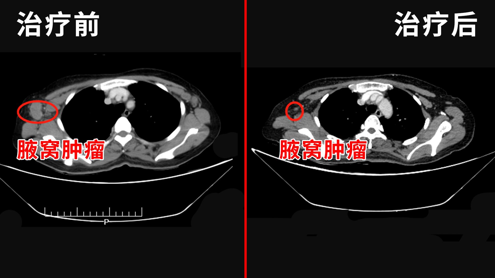 乳腺癌晚期破溃流脓能活多长时间,乳腺癌破溃流黄水