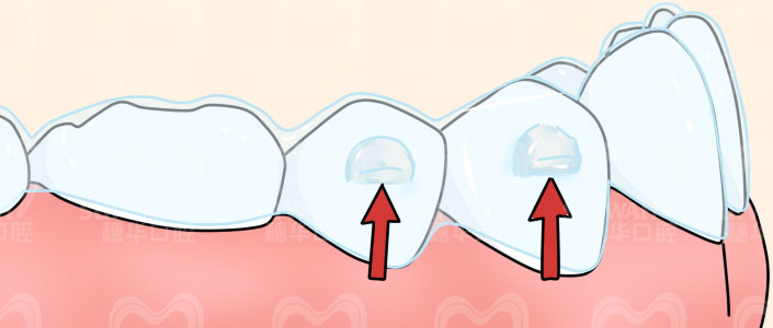 疫情期间牙矫正怎么办,疫情期间牙套复诊不了