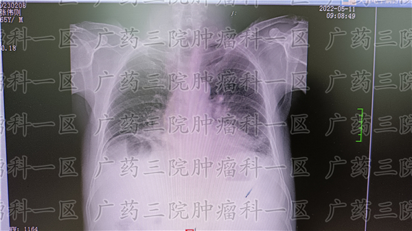 乳房有肿块良性用切除吗,乳房有肿块需要吃药吗