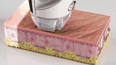 有什么方法能淡化妊娠纹呢,淡化妊娠纹用这个方法简单又实用