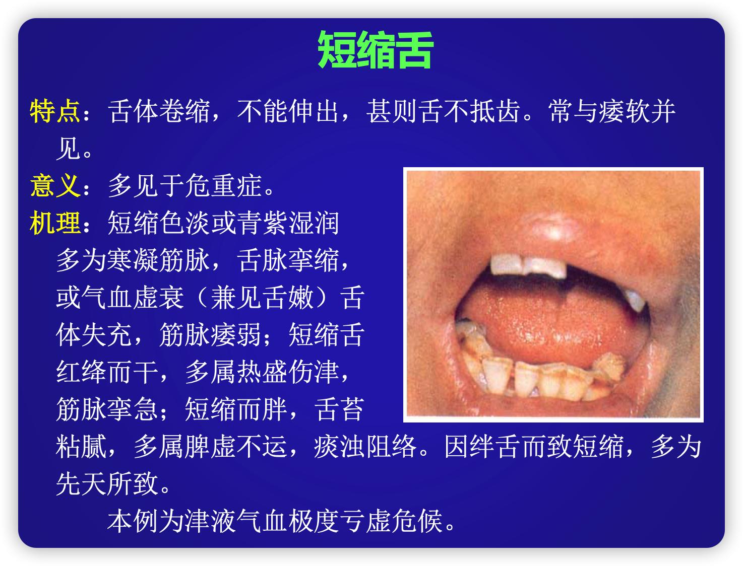 舌诊不难:解读颤动舌、吐弄舌和短缩舌