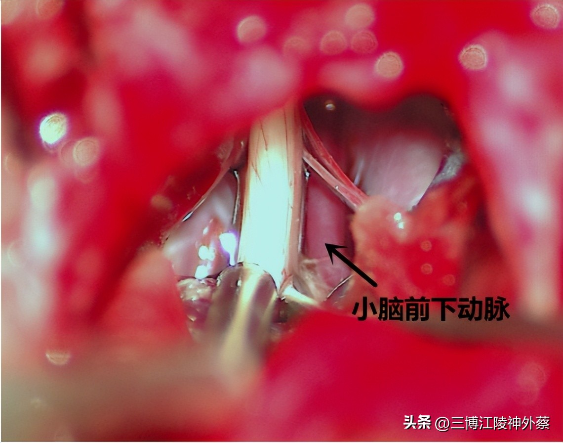 「案例」同侧同时出现面肌痉挛和三叉神经痛,如何治疗?