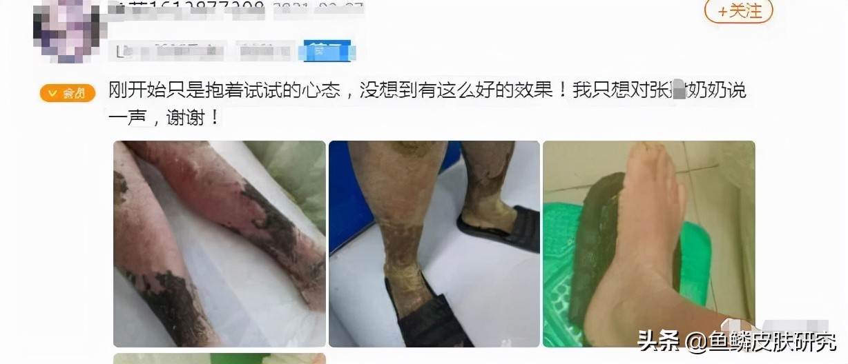 鱼鳞病康复者的自述,寻常性鱼鳞病看病经验分享