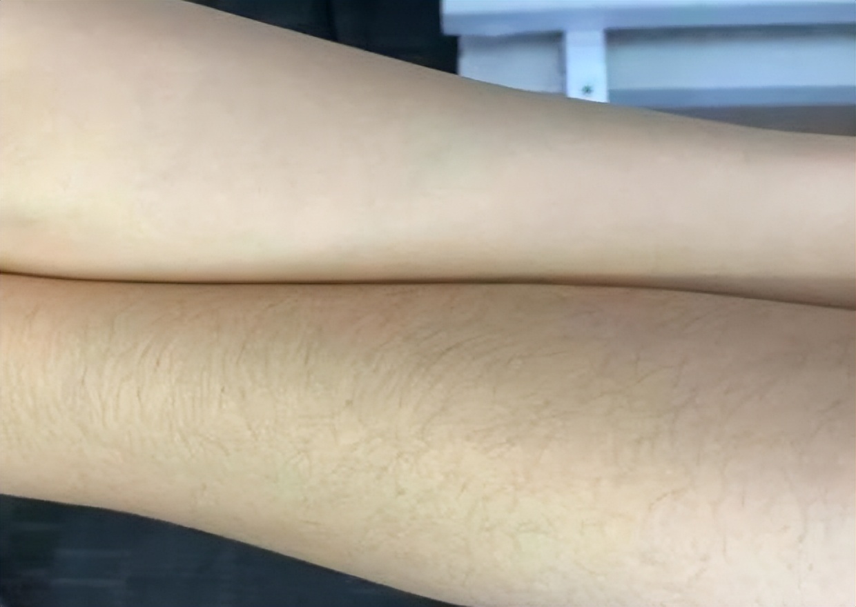 女性体毛生长旺盛与哪些原因有关,关于女性体毛过多的真实原因