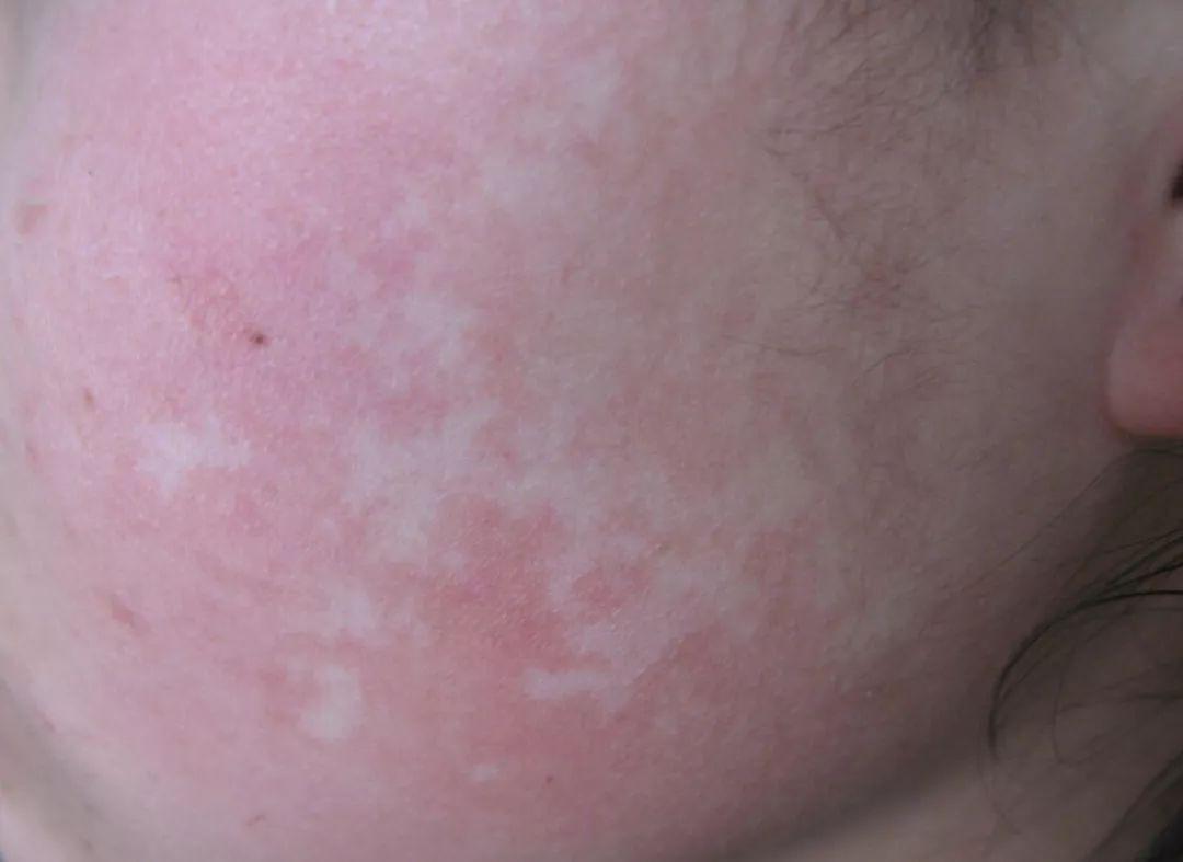 有什么白斑是不用治疗的,白斑怎样治疗才能消失呢