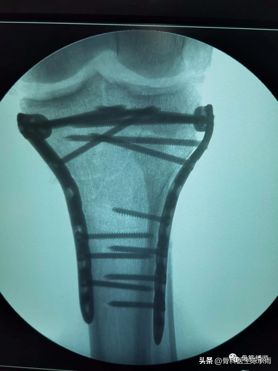 膝关节胫骨平台骨折,最近胫骨平台骨折视频