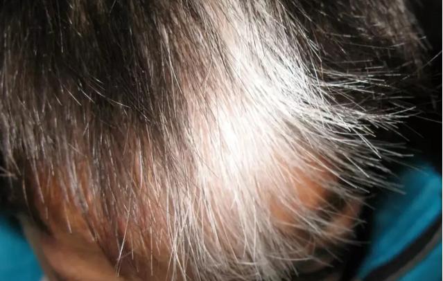 前额和后脑勺有白发,前额后脑勺长白发什么原因