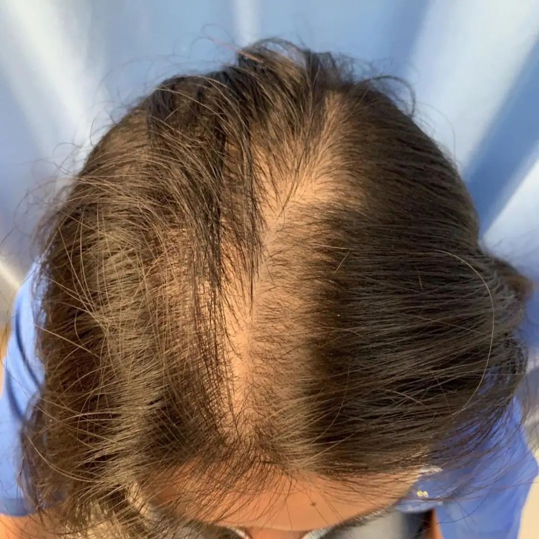 发际线处头发稀少怎么调理,中医怎么治疗发际线高头发稀少