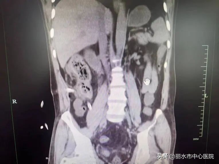 多学科合作治愈腹腔巨大肿瘤