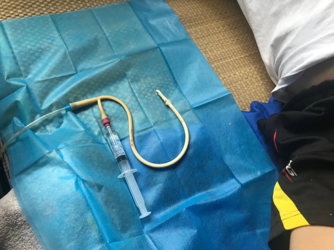 高龄老人居家更换导尿管,照顾老人换尿管